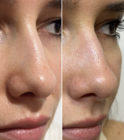 SKENS Patchs Nez - 8 Patchs - DISPONIBLE À NOUVEAU !