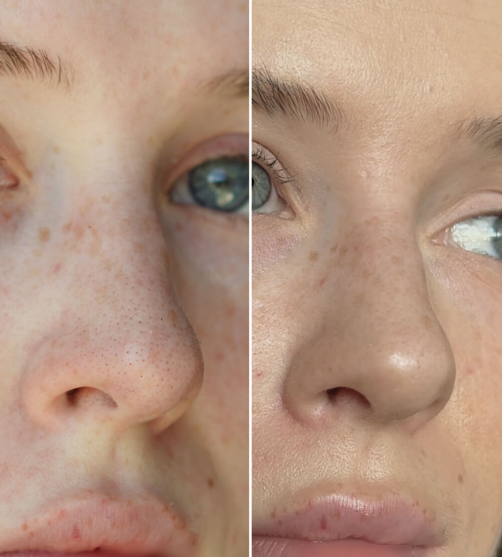 SKENS Patchs Nez - 8 Patchs - DISPONIBLE À NOUVEAU !