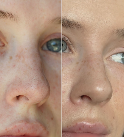 SKENS Patchs Nez - 8 Patchs - DISPONIBLE À NOUVEAU !