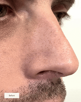 SKENS Patchs Nez - 8 Patchs - DISPONIBLE À NOUVEAU !