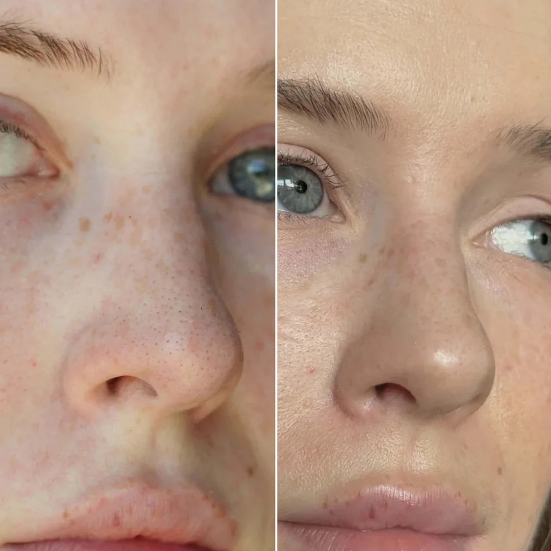 SKENS Patchs Nez - 8 Patchs - DISPONIBLE À NOUVEAU !