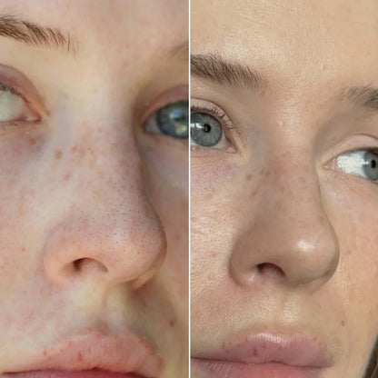 SKENS Patchs Nez - 8 Patchs - DISPONIBLE À NOUVEAU !