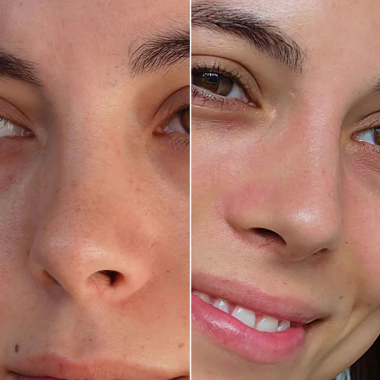 SKENS Patchs Nez - 8 Patchs - DISPONIBLE À NOUVEAU !