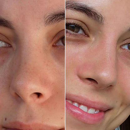 SKENS Patchs Nez - 8 Patchs - DISPONIBLE À NOUVEAU !